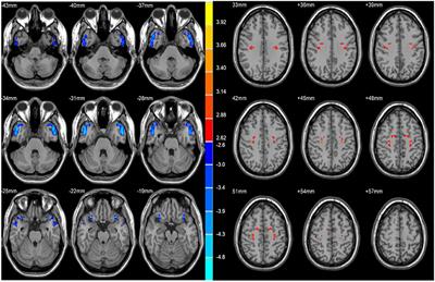 Altered voxel-mirrored homotopic connectivity in right temporal lobe epilepsy as measured using resting-state fMRI and support vector machine analyses